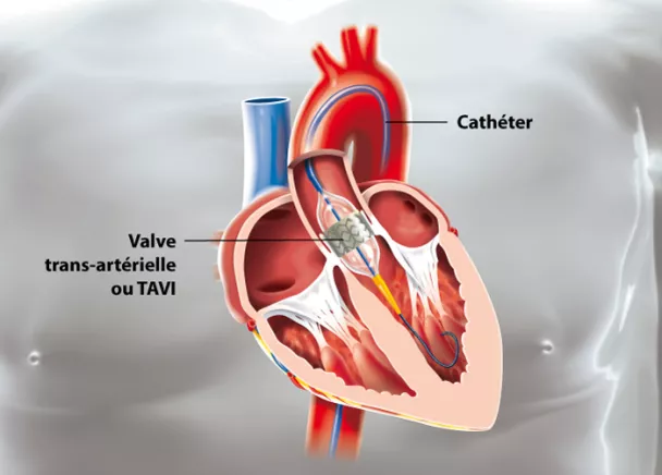 Implantation d'une valve aortique par voie percutanée(TAVI)