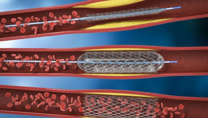 Angioplastie coronarienne avec ou non pose de stent