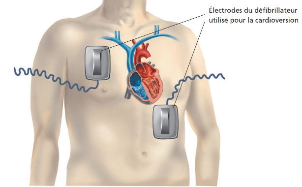 Cardioversion électrique