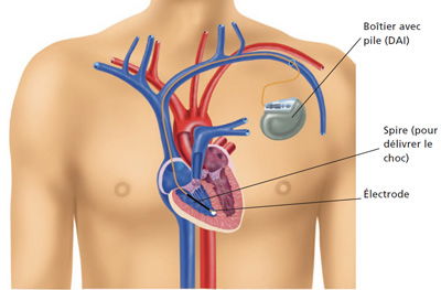 Pose d'un défibrillateur automatique implantable (DAI)