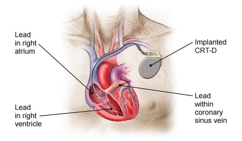 Implantation de CRT (thérapie de resynchronisation cardiaque)