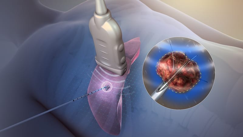 Examen électrophysiologique/ Ablation par radiofréquence