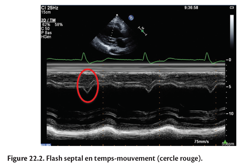 Échocardiographie avec étude de l'asynchronisme ( CRT)