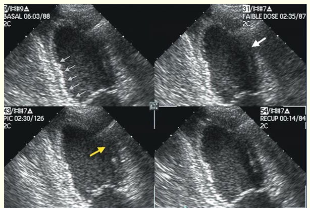 Échocardiographie pharmacologique (Écho Dobu)