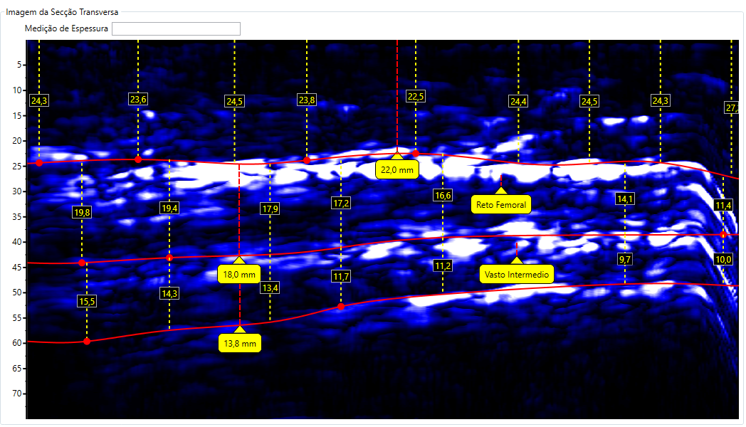 Escaneamento da Coxa