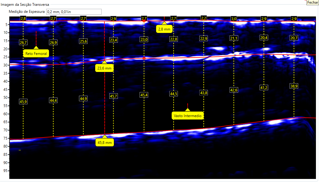 Escaneamento da Coxa