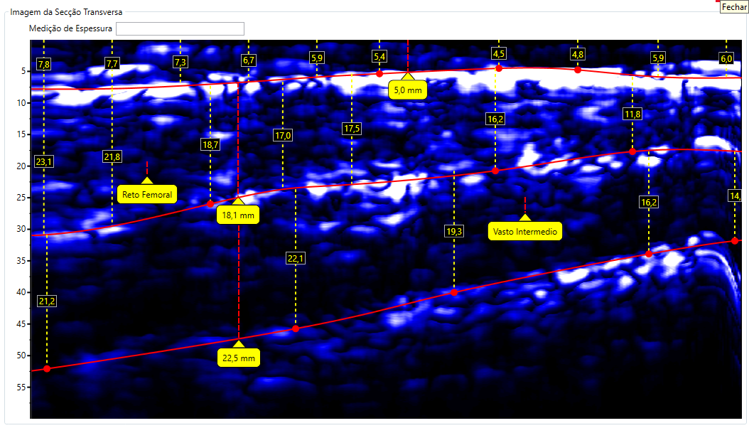 Escaneamento da Coxa