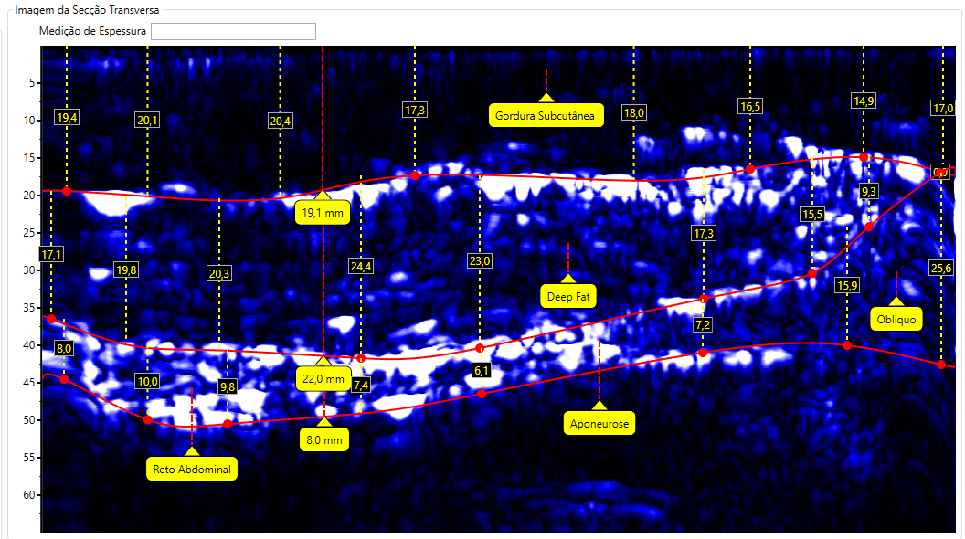 Escaneamento de Abdômen
