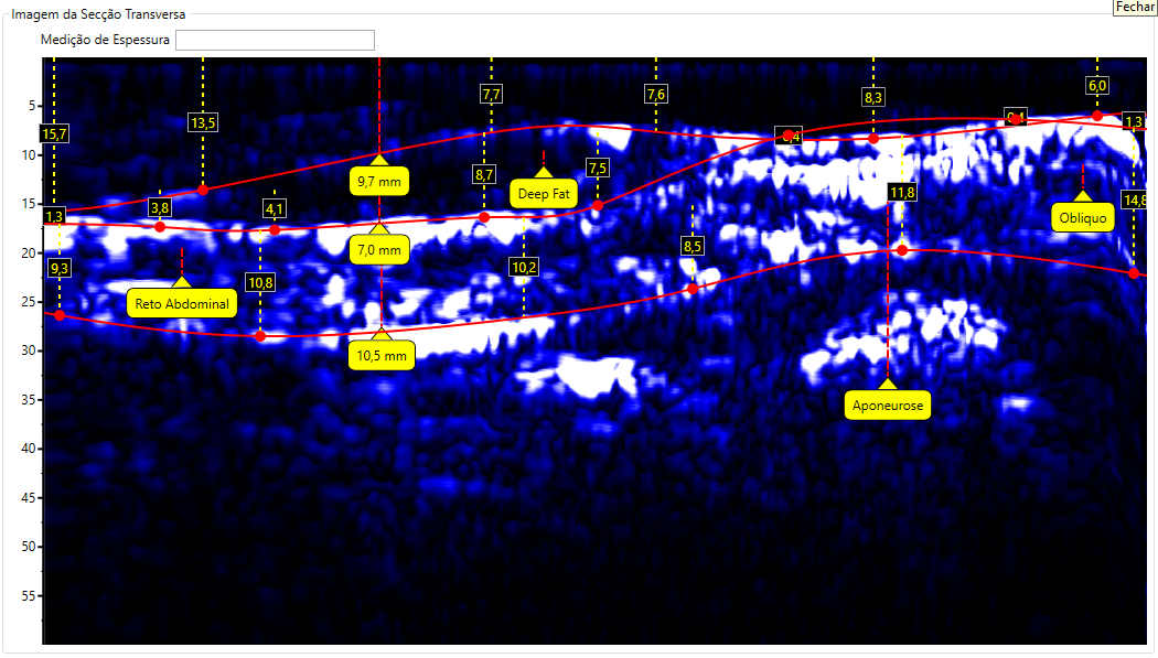 Escaneamento de Abdômen