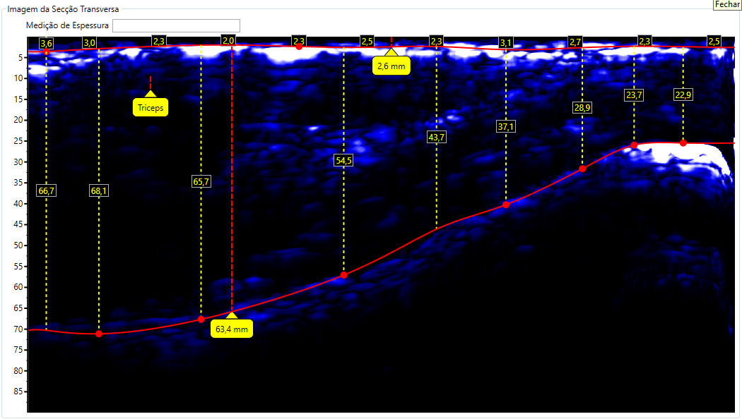 Escaneamento de Tríceps