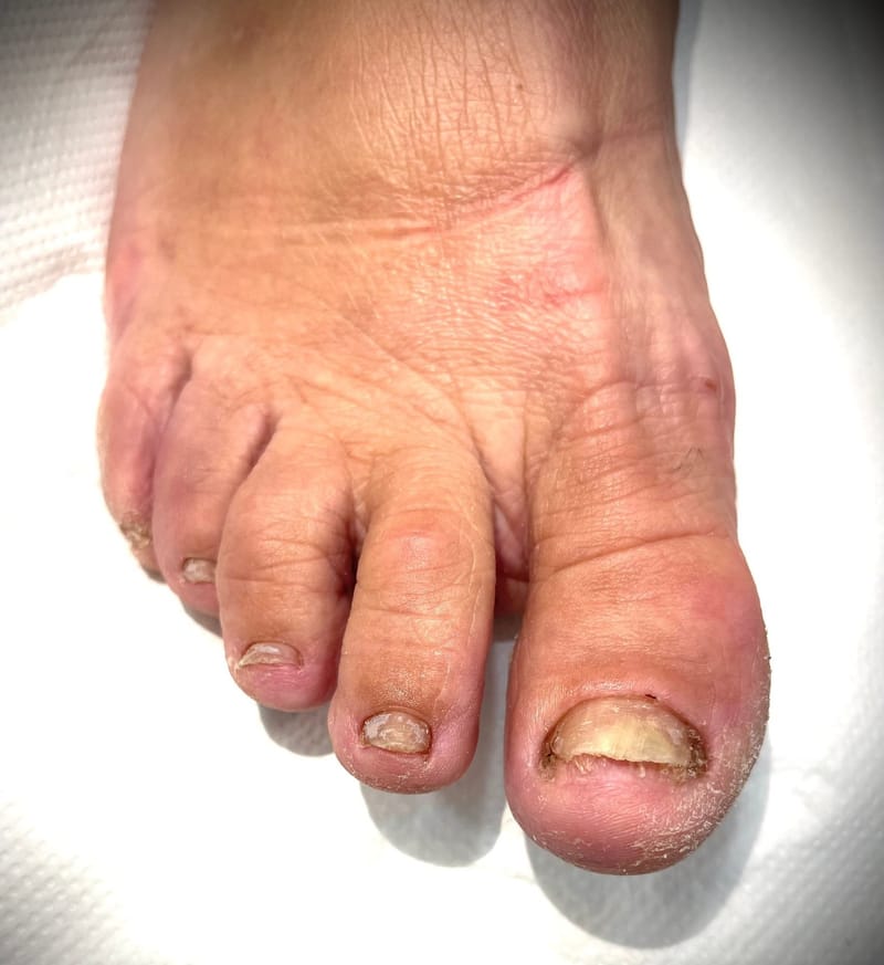 Körömgomba kezelés