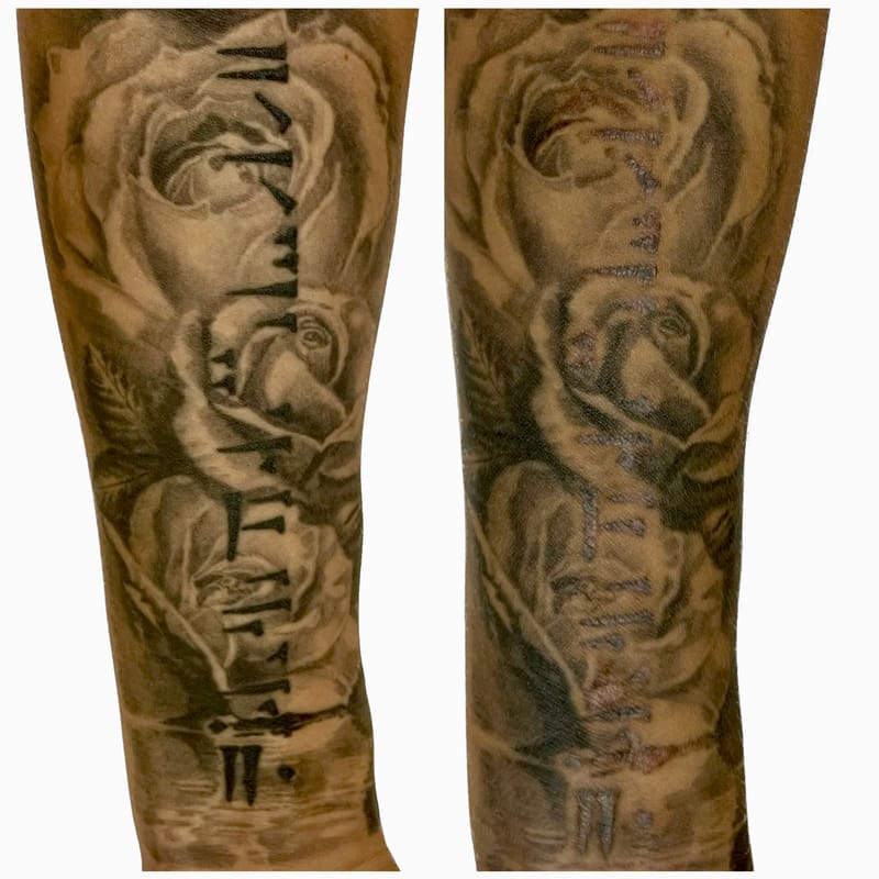 Test és kozmetikai tetoválás részleges vagy teljes eltávolítás