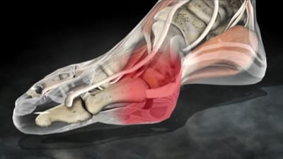 6 RAZONES POR LAS QUE DEBERÍAS OPERARTE EL PIE POR CIRUGÍA MÍNIMAMENTE INVASIVA