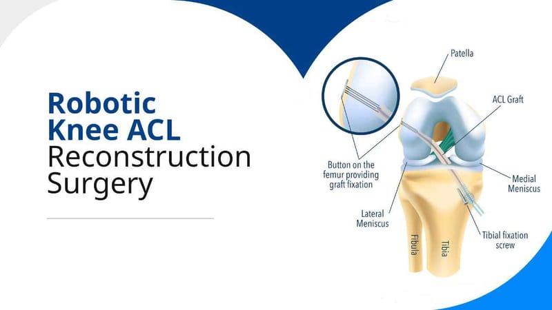 Robotic Knee ACL Reconstruction Surgery