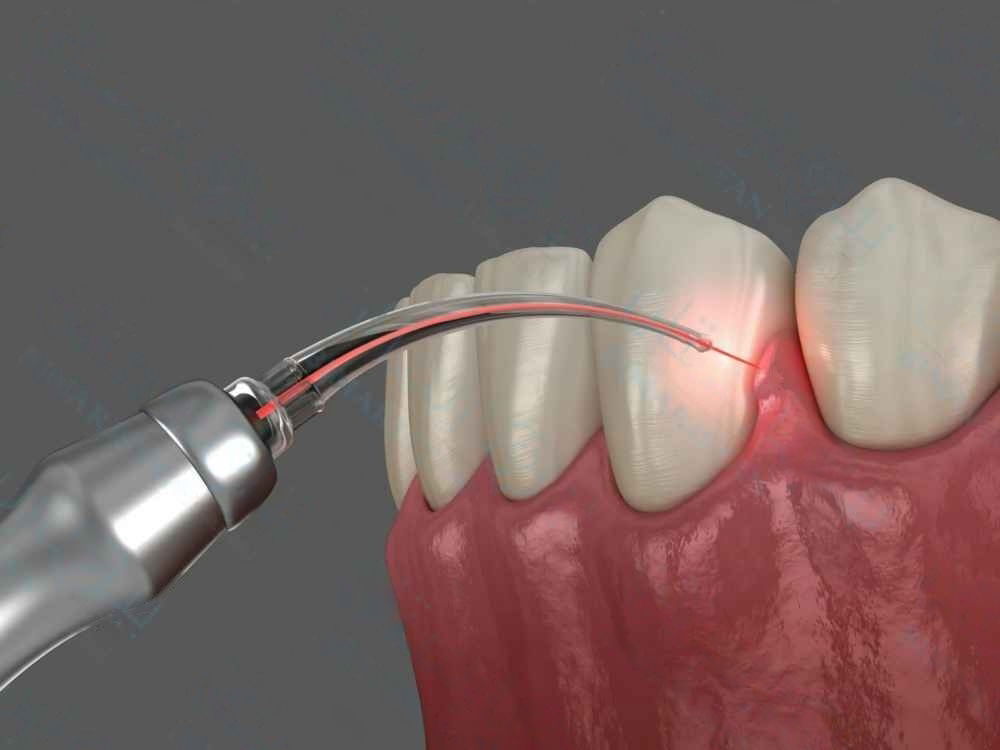 علاج الأسنان بالليزر