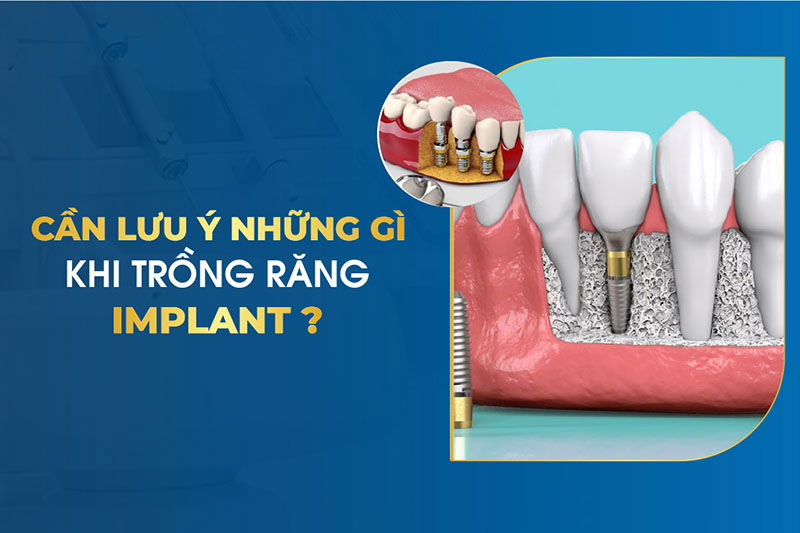 Lưu ý gì khi trồng răng Implant để không đau và phục hồi tốt?