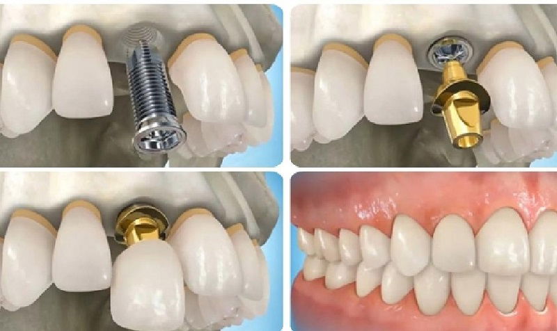 Tiểu đường cấy Implant có đau không? Chú ý gì khi trồng Implant?