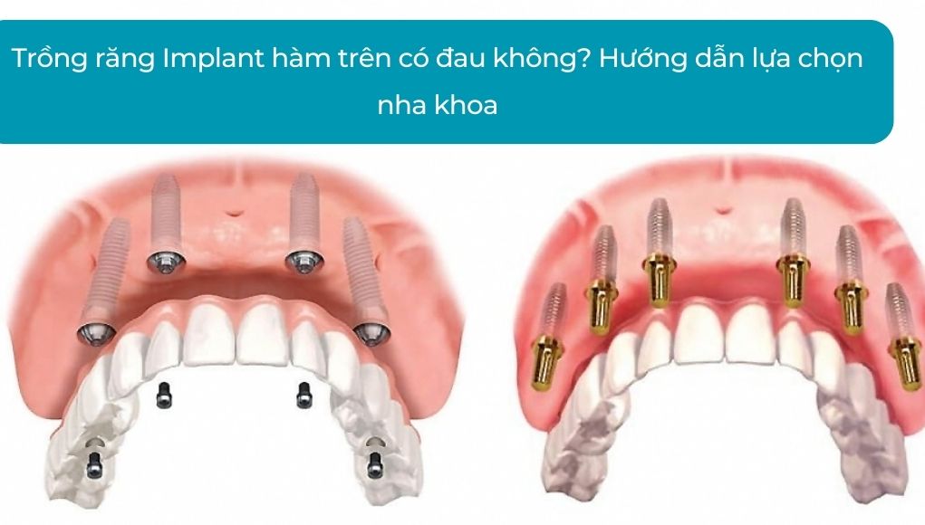 Trồng răng Implant hàm trên có đau không? Hướng dẫn lựa chọn nha khoa uy tín cấy ghép Implant