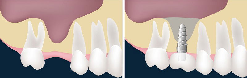 Trồng răng Implant có đau không nếu nâng xoang? Cách nâng xoang