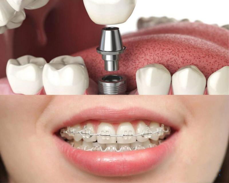 Trồng răng Implant sau niềng răng có nên không?