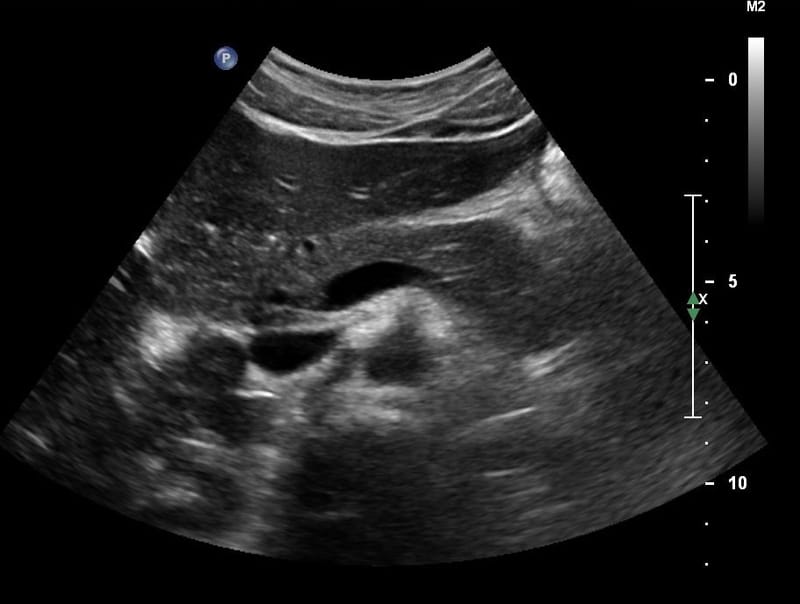Taller de Ecografía Abdominal