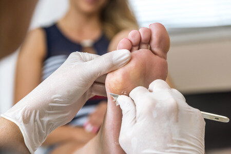 Callus Treatment