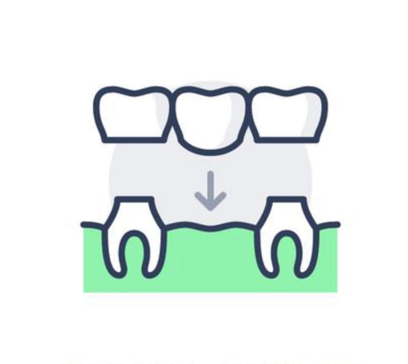 Dental Bridge