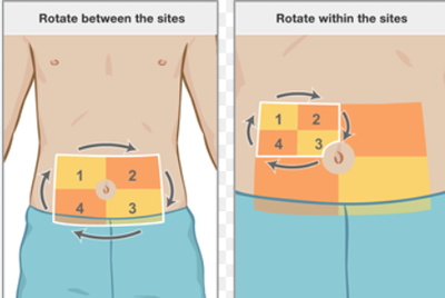 Rotating Injection Sites