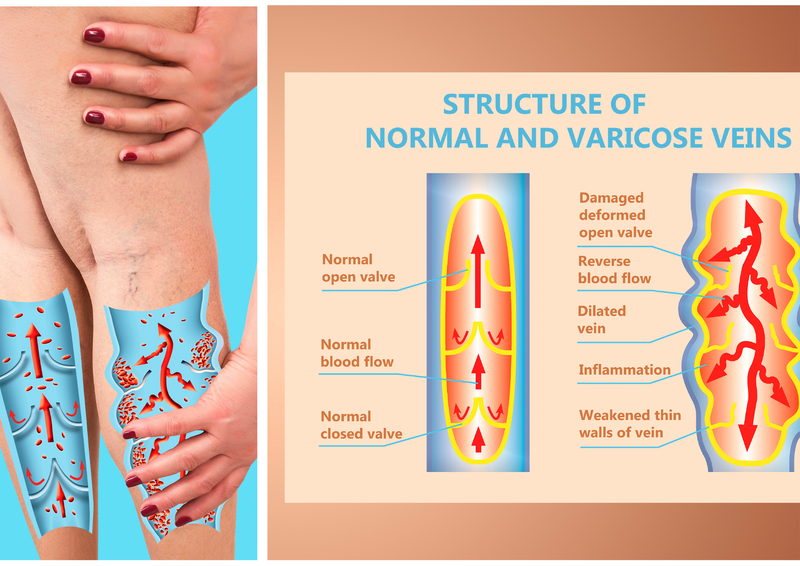 VARICOSE VEINS