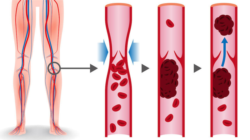 DEEP VENOUS THROMBOSIS (DVT)