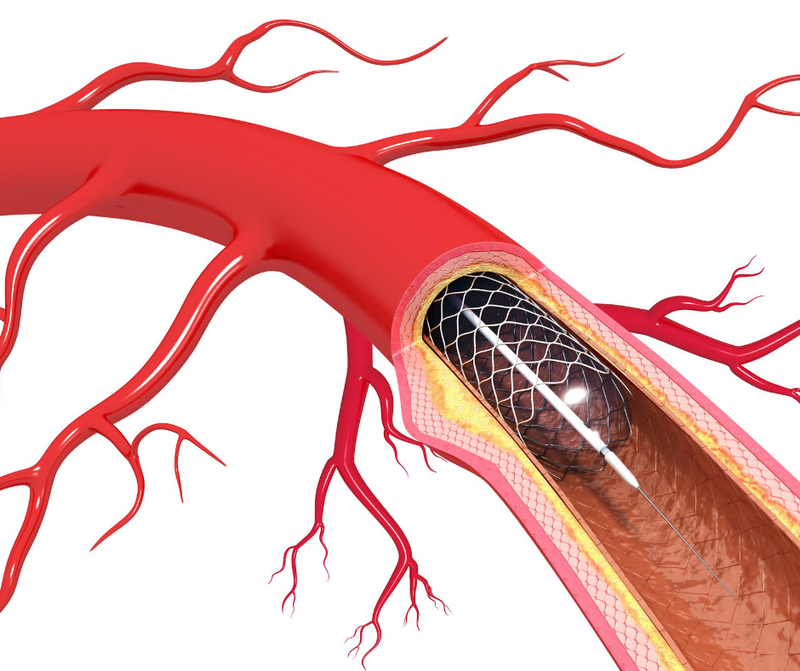 Carotid Stenting