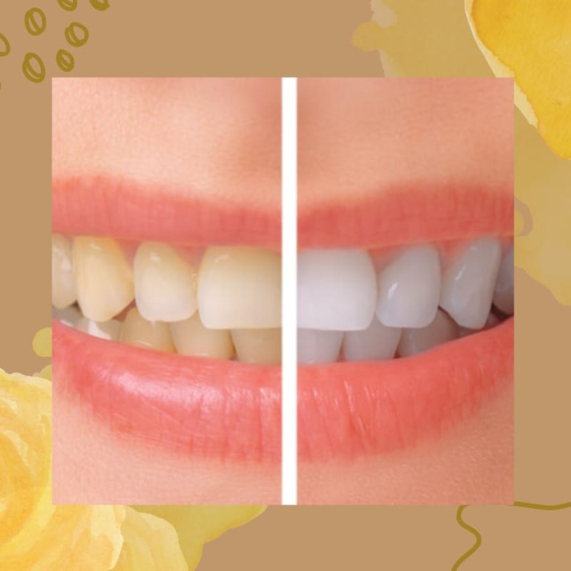 Teeth Whitening