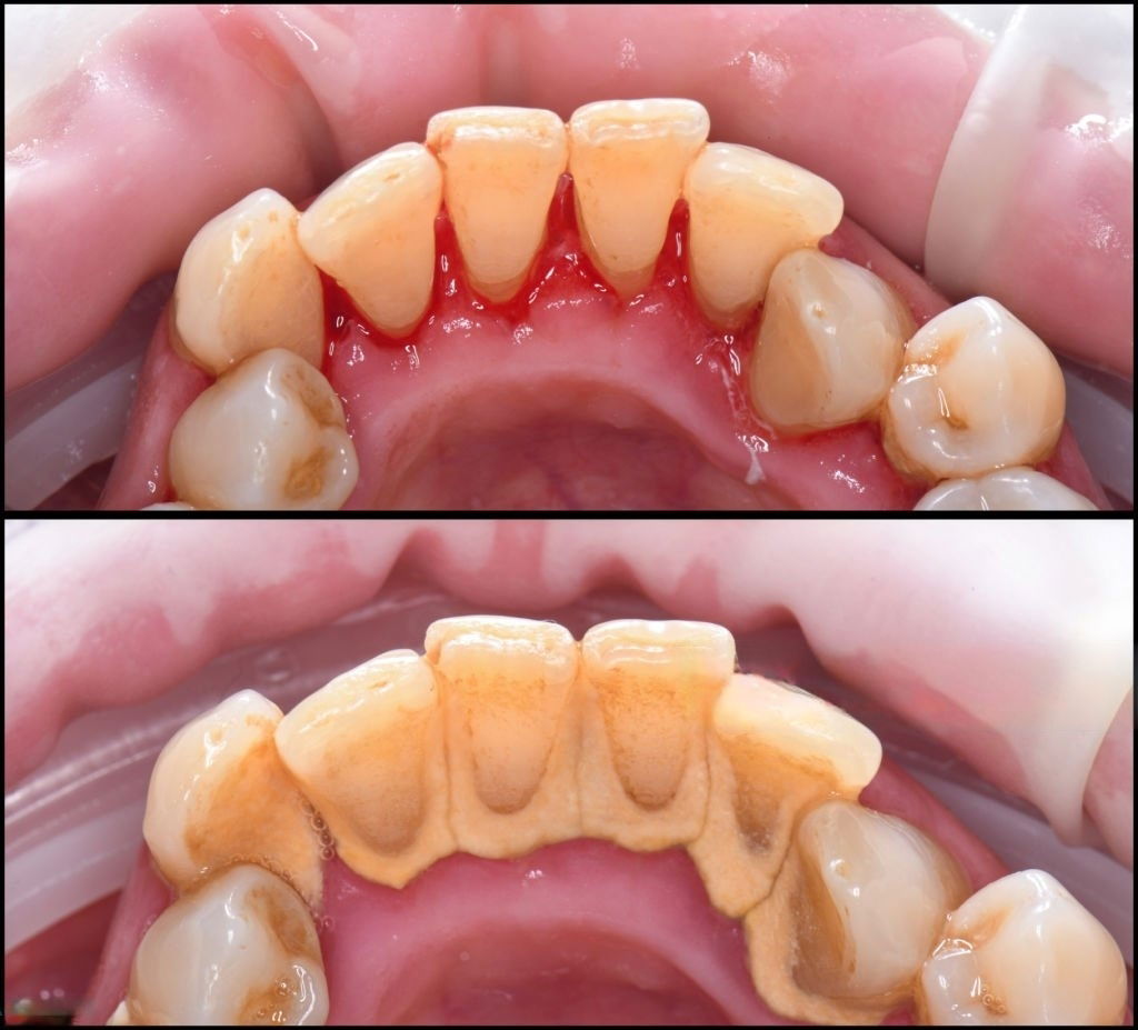 Diş Taşı Temizliği Zararlı mıdır?