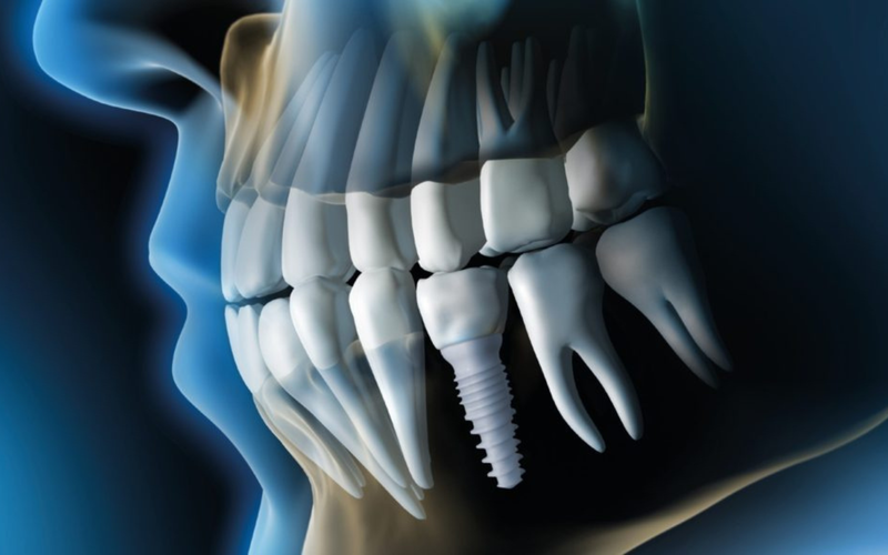 Zirconia Dental Implants