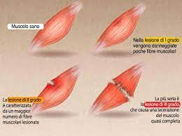 Strappi Muscolari vs Stiramenti: Differenze e Approcci di Fisioterapia