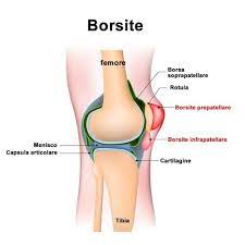 Borsite e Riabilitazione: Come il Fisioterapista Può Favorire la Guarigione