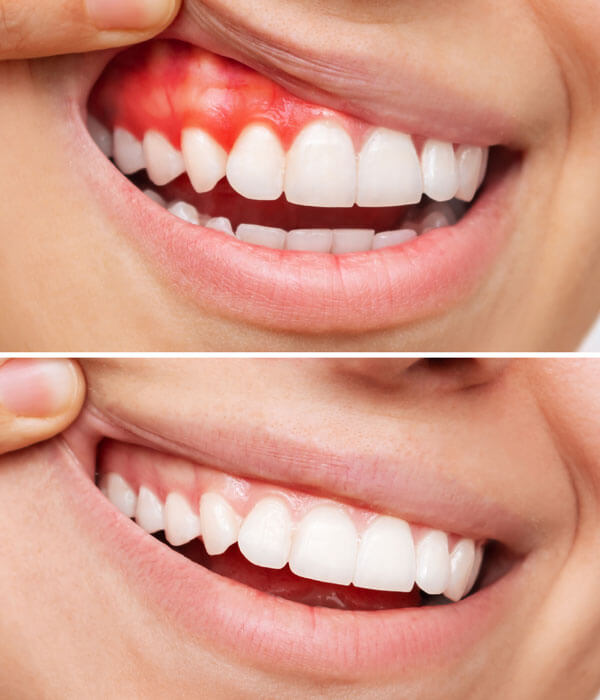 علاج وتجميل اللثة