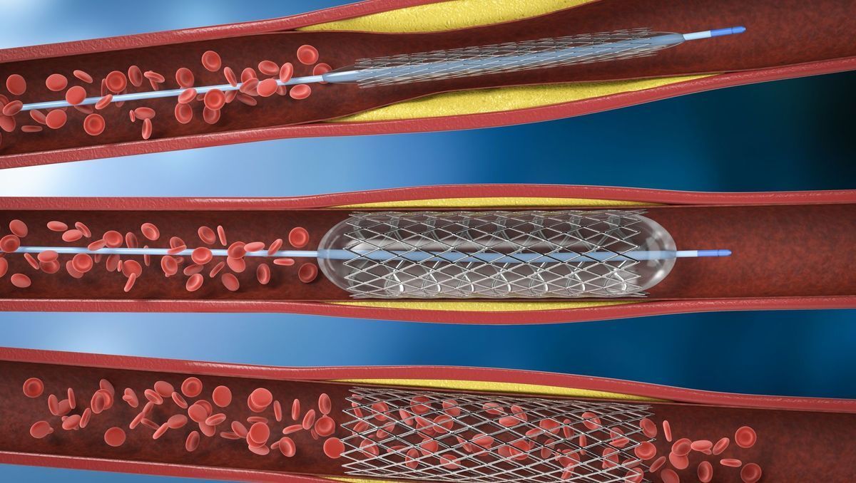 L'angioplastie et la pose de stents