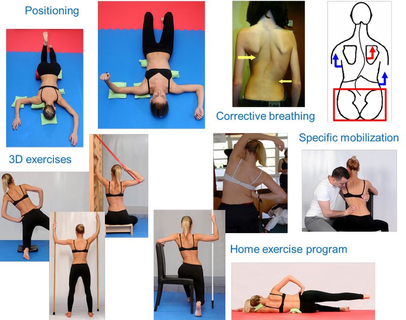 Schroth / 3D Scoliosis terápia