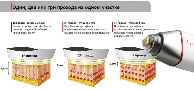 Фракционный RF-лифтинг с микроиглами