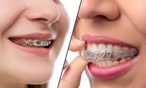 Braces/Aligners