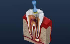 rootcanal treatment