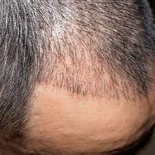 Achieving Permanent Confidence: The Promise of Natural-Looking Hair Transplants