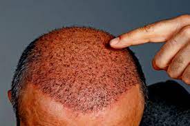 About Hair Transplant Clinics