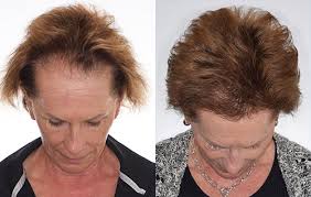Hair Restoration in Dubai UAE At Royal Clinic | Al Wasl Road ?