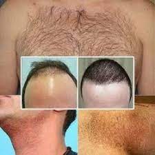 How to Choose the Most Effective Hair Surgery