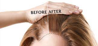 Step-by-Step Guide to Getting a Hair Transplant in Dubai