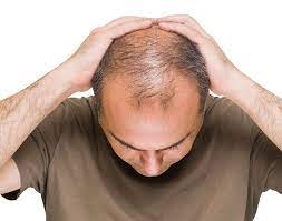 Is There a Way to Predict How Long Hair Replacement Will Last?