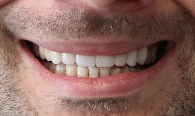 ¿Qué Diferencia A Nuestros Servicios De Implantes Dentales?