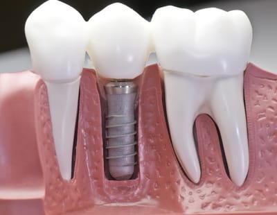 Los Beneficios De Los Implantes Dentales Para La Pérdida De Múltiples Dientes